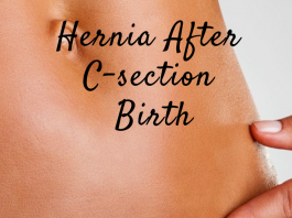 Hernia after C-Section