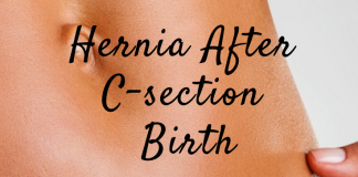 Hernia after C-Section