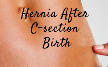 Hernia after C-Section