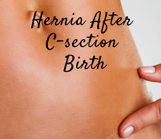 Hernia after C-Section