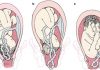 Umbilical Cord Prolapse