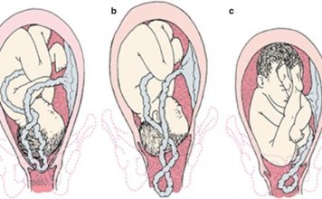 Umbilical Cord Prolapse