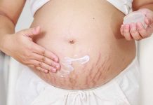 Purple stretch marks: risks and home remedies