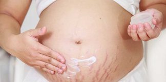 Purple stretch marks: risks and home remedies