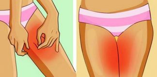 vaginal chafing