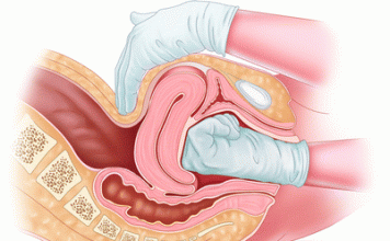 Uterine Atony