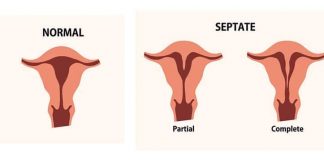 Septate Uterus