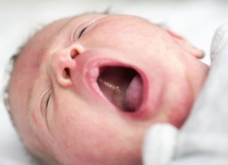 Epstein Pearls In Babies