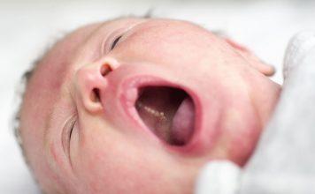 Epstein Pearls In Babies