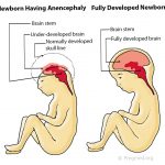 Anencephaly