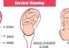 cervical ripening