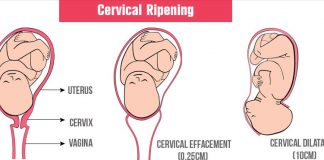 cervical ripening