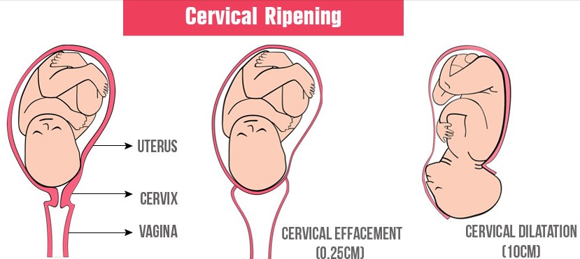cervical ripening