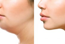 neck fat