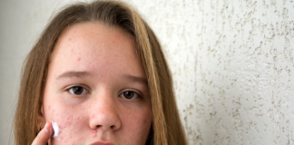 teenage acne