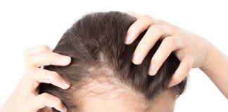 hairfall in women with pcos