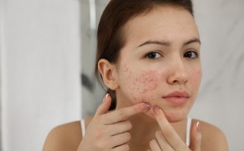 teen acne