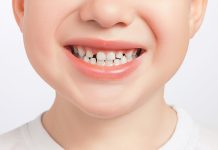 hyperdontia in children remedies