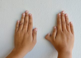 limb deformities in children