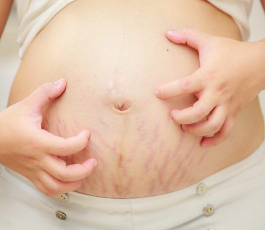 intrahepatic cholestatis of pregnancy