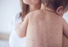 impetigo in children