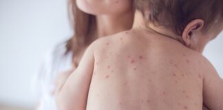 impetigo in children